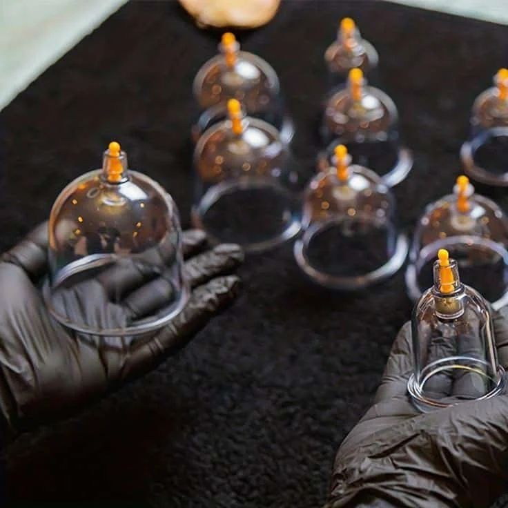 What is Cupping Therapy?