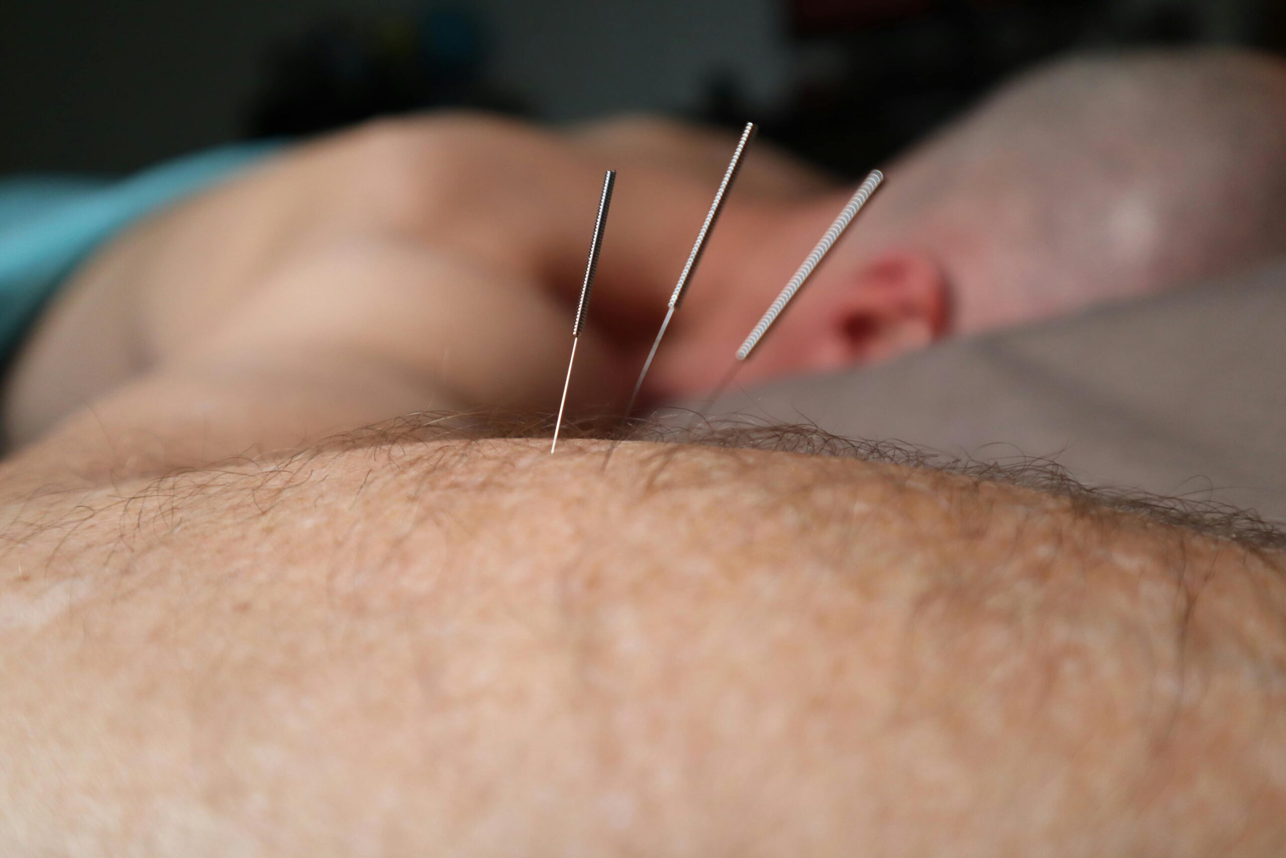 The Best Dry Needling Physiotherapy Specialists in Nairobi