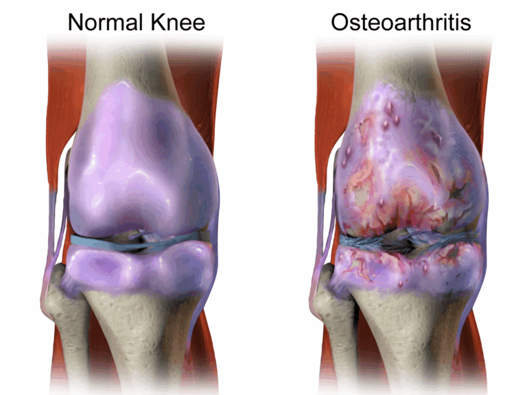 The Difference Between Osteoarthritis and Rheumatoid Arthritis