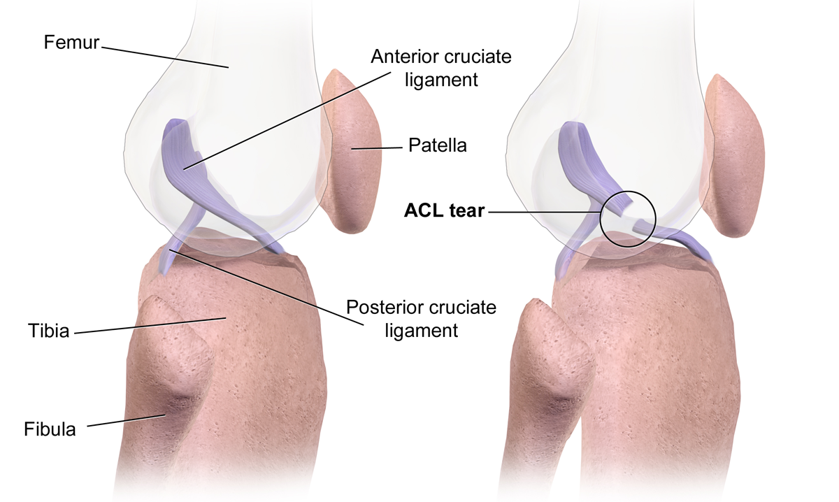 ACL Tear Physiotherapy Services in Nairobi